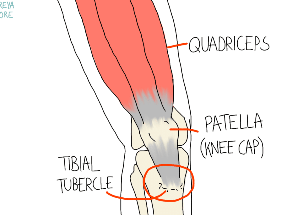 Osgood Schlatter Disease