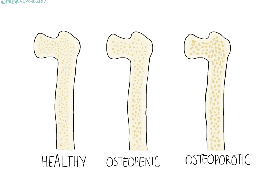 Osteoporosis and Osteopenia