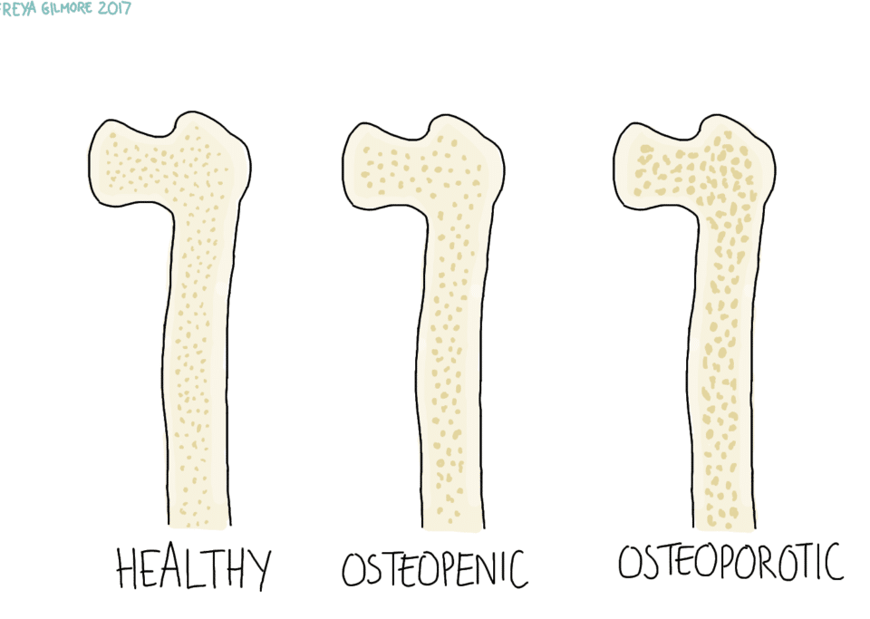 Osteoporosis and Osteopenia