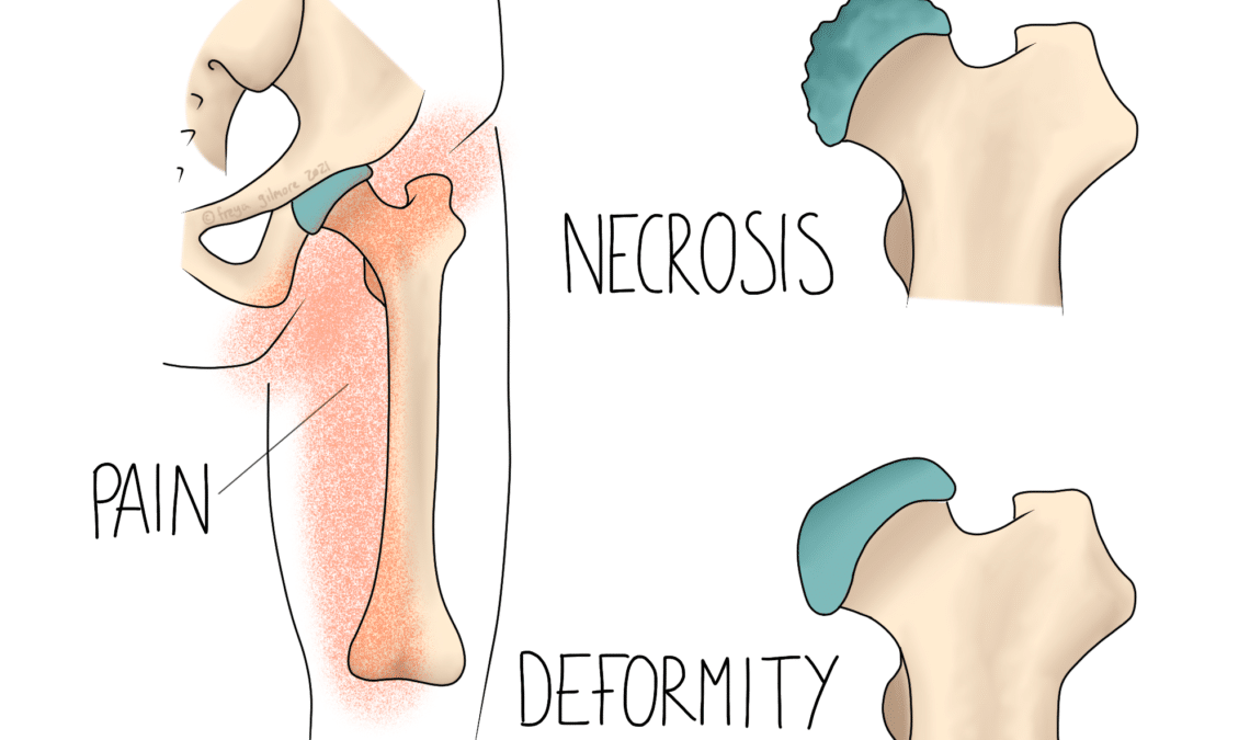 Perthes' Disease