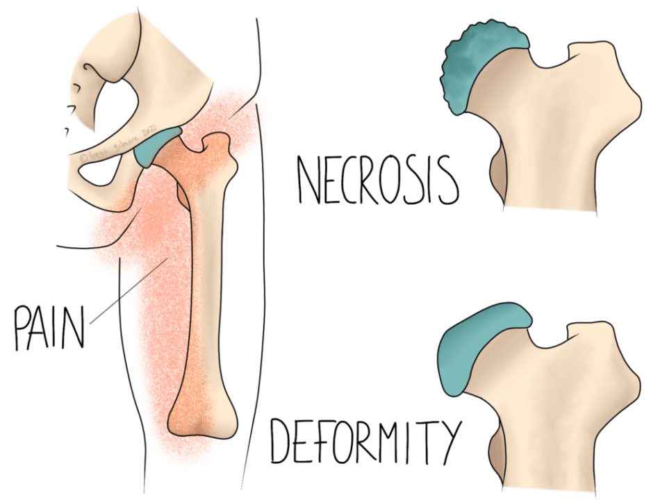 Perthes' Disease