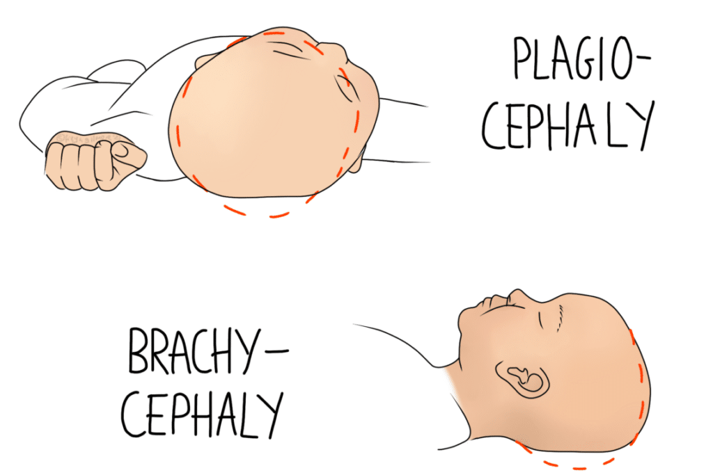 Plagiocephaly and brachycephaly