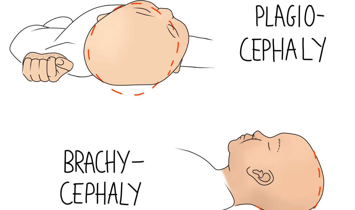 Plagiocephaly and brachycephaly