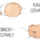 Plagiocephaly and brachycephaly