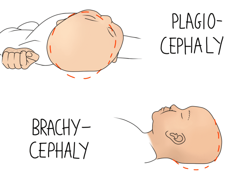 Plagiocephaly and brachycephaly