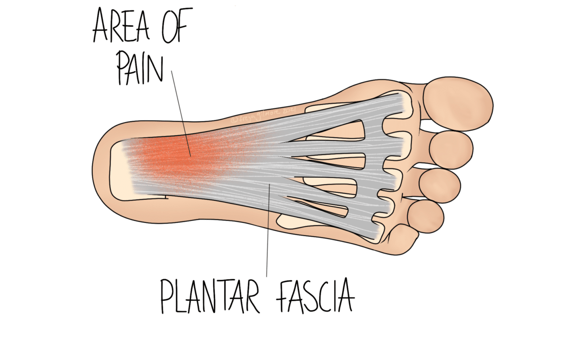 Plantar Fasciitis