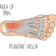 Plantar Fasciitis