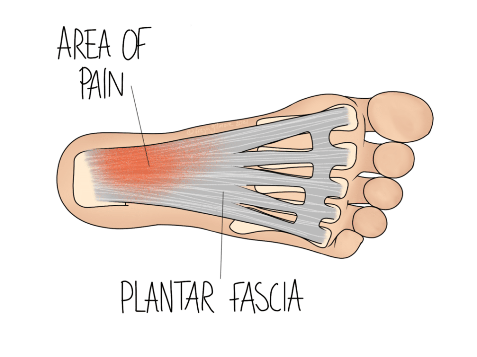 Plantar Fasciitis