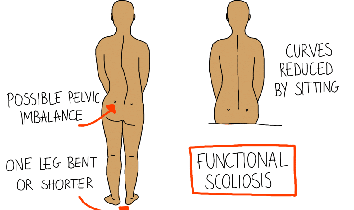 Scoliosis