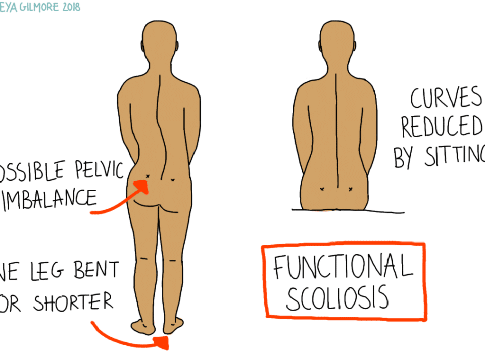 Scoliosis