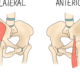 Snapping Hip Syndrome