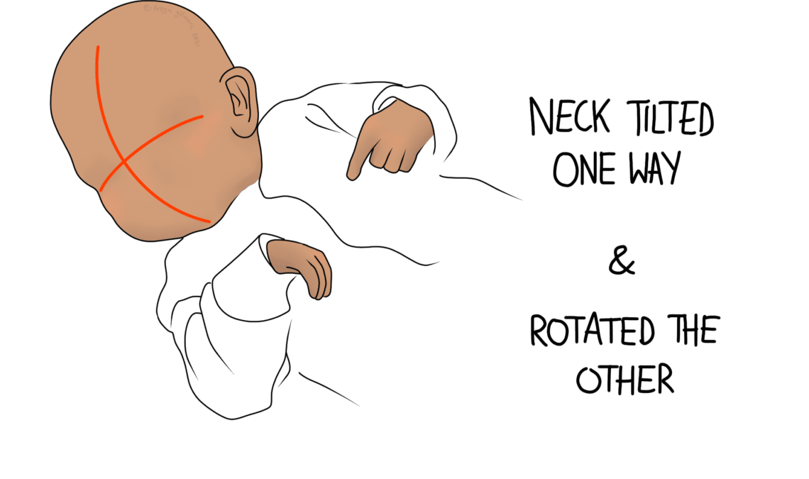 torticollis