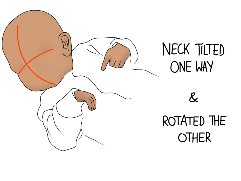 torticollis