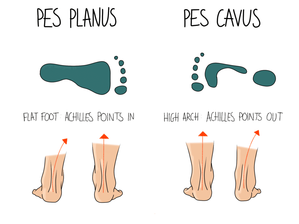 Flat feet (pes planus) and high arches (pes cavus)