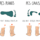 Pes Planus Pes Cavus