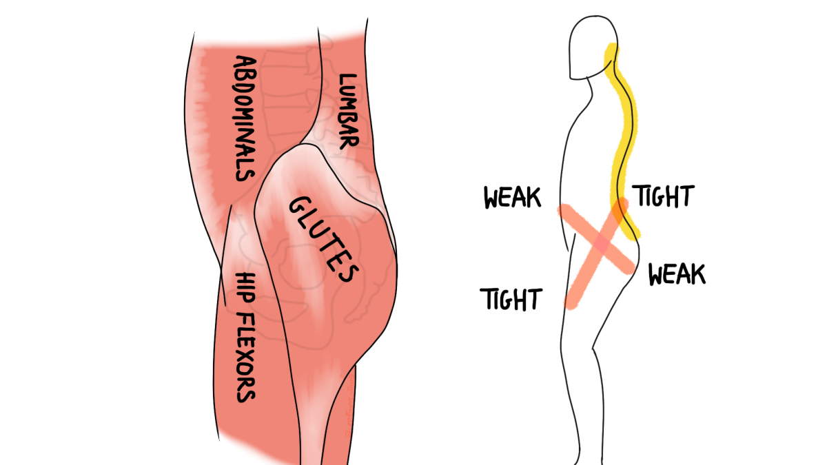 Lower cross syndrome