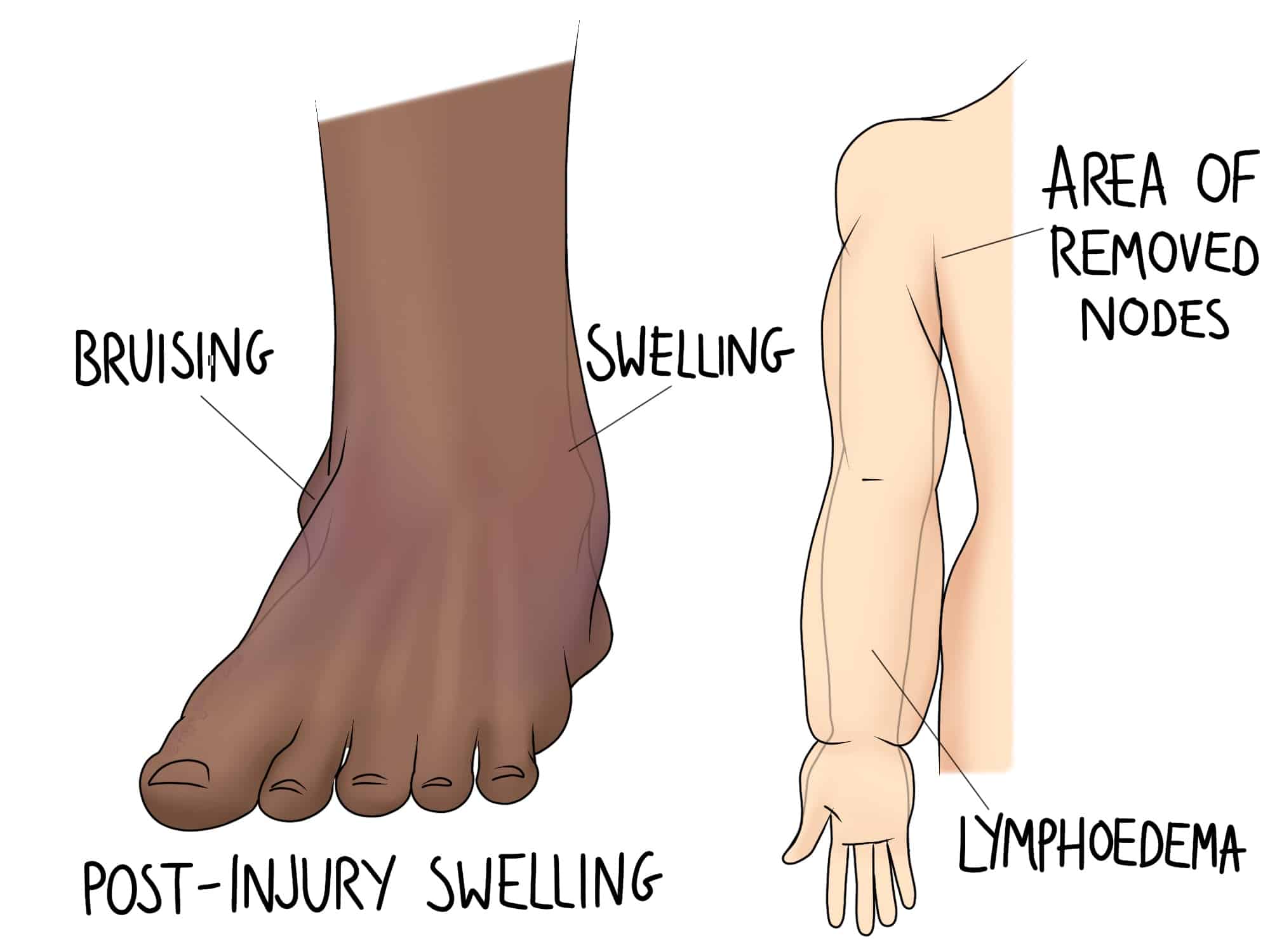 A diagram showing a swollen, bruised foot with labels "BRUISING" and "POST-INJURY SWELLING." Beside it, an arm with labels "AREA OF REMOVED NODES" and "LYMPHOEDEMA."