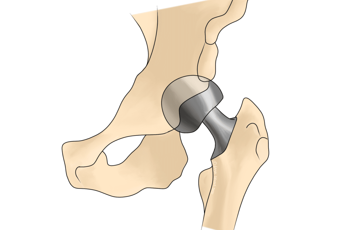 A metal hip joint implant is illustrated, showing how it fits within the pelvic bone. The smooth, metallic surface contrasts with the beige skeletal structure surrounding it.