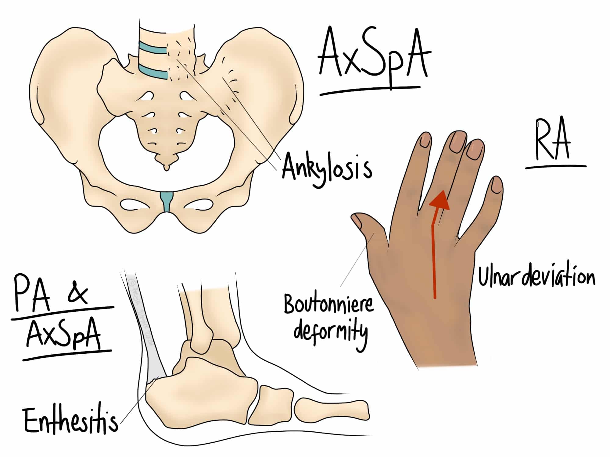 Pelvic bones, hand, and foot are depicted, showing skeletal conditions. Text: "AxSpA, Ankylosis, RA, Ulnar deviation, PA & AxSpA, Enthesitis, Boutonniere deformity." Arrows indicate specific deformations.