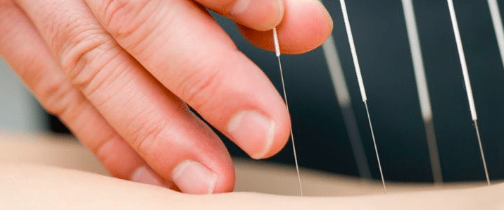 A hand is carefully placing thin acupuncture needles into skin, set against a blurred background.