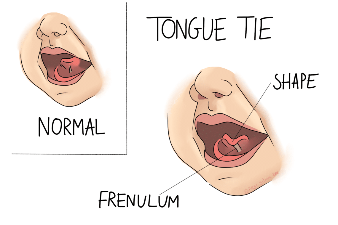 Two side-by-side illustrations show a human mouth. Left: a normal tongue; right: a tongue with a tie. Labels indicate "Normal," "Tongue Tie," "Shape," and "Frenulum."