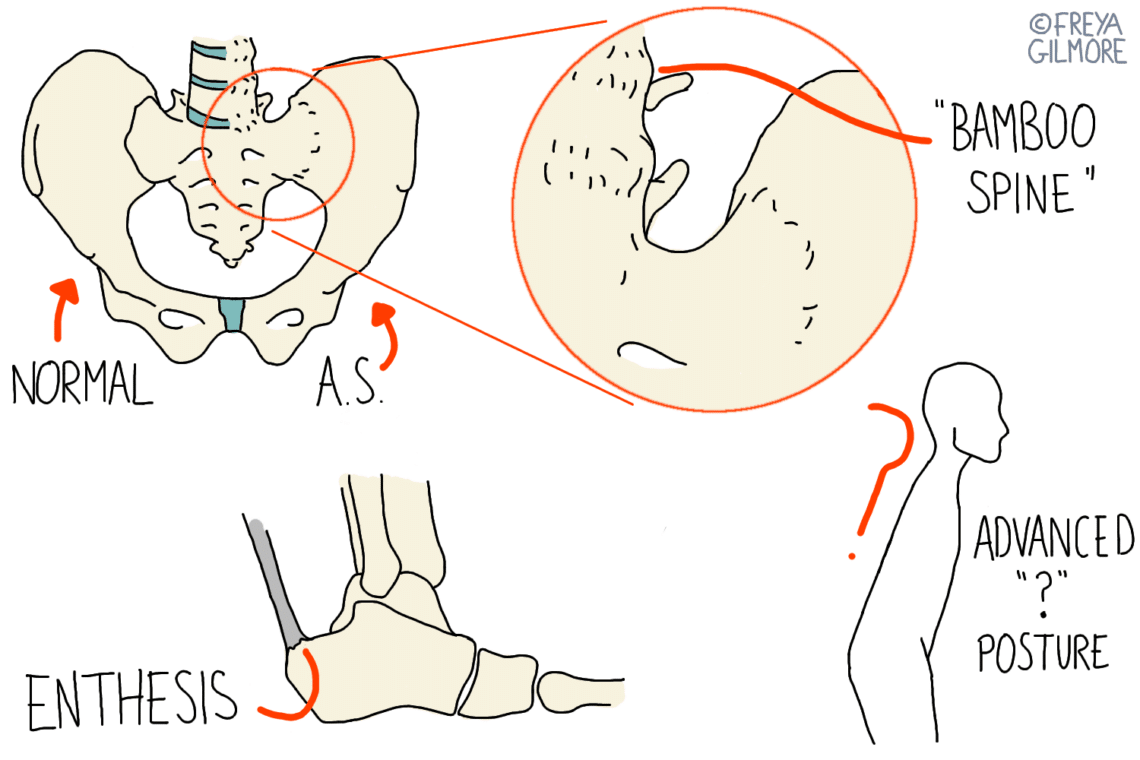 Pelvic bones illustrate "normal" and "A.S." conditions with a zoomed view labeled "bamboo spine." A foot displays "enthesis" inflammation. A silhouette shows "advanced" posture, questioning mark. Text by Freya Gilmore.