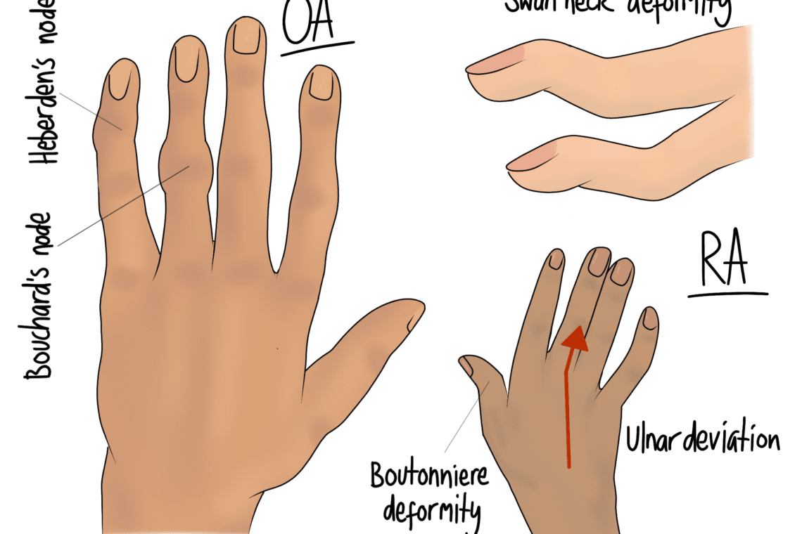 Two hands depicting arthritis-related deformities. The left hand shows "OA" with Heberden's and Bouchard's nodes. The right hand shows "RA" with swan neck deformity, Boutonniere deformity, and ulnar deviation.