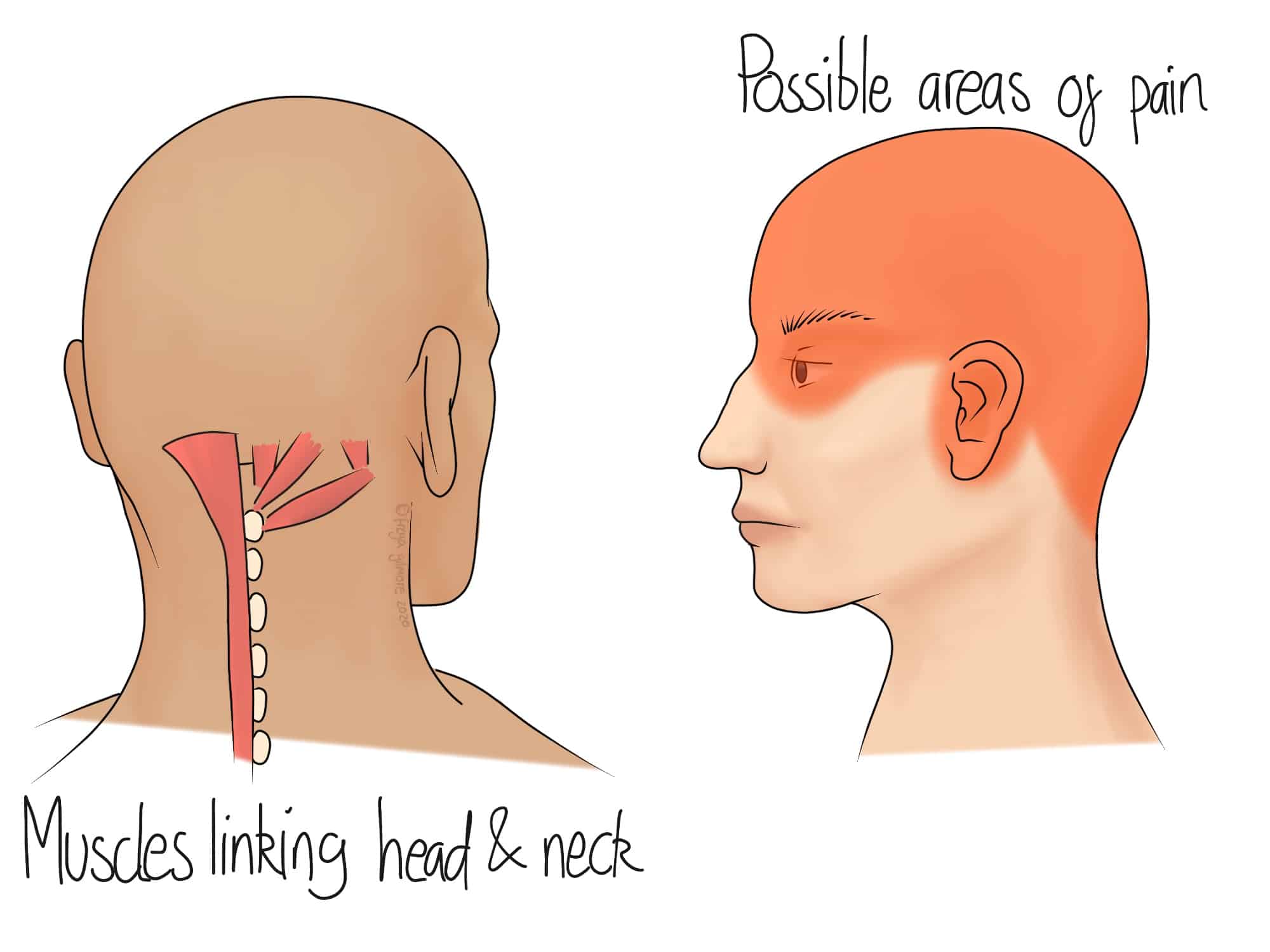 Two illustrations show a person's head and neck. The left highlights neck muscles, labeled "Muscles linking head & neck." The right shows shaded areas on the face and head, labeled "Possible areas of pain."