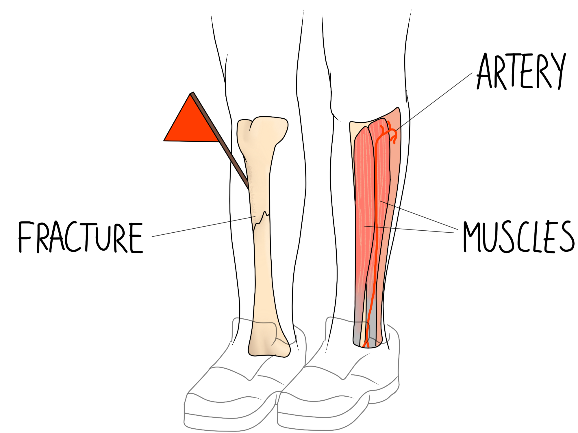 Left leg with fractured bone and triangular hazard symbol indicated, right leg shows muscles labeled "MUSCLES" and "ARTERY", both legs are wearing shoes. Text: "FRACTURE", "MUSCLES", "ARTERY".