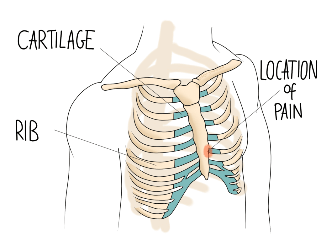 An anatomical illustration showing ribs, cartilage, and highlighted pain location near the sternum. Labels include "CARTILAGE," "RIB," and "LOCATION of PAIN," indicating thoracic structure.