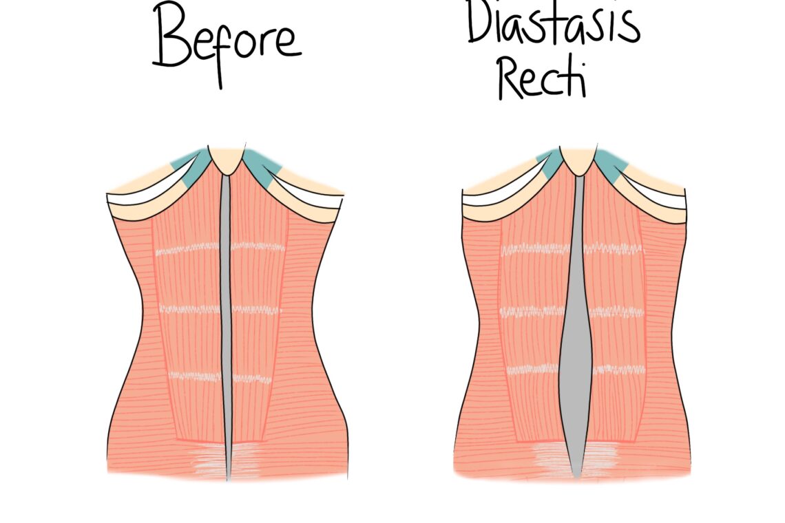 Two diagrams show abdominal muscles. The left is labeled "Before," with intact muscles. The right is labeled "Diastasis Recti," displaying separated muscles with a gap.