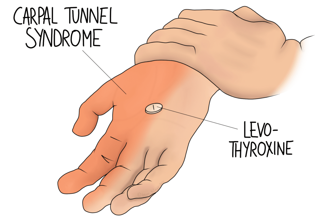 A hand with a highlighted area on the wrist, indicating pain, labeled "Carpal Tunnel Syndrome." A small pill labeled "Levo-thyroxine" is shown on the palm.