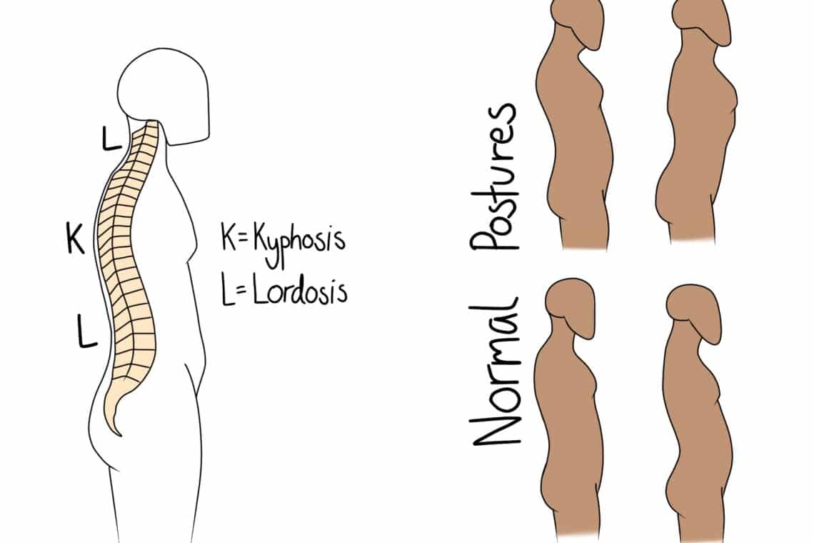 A human figure displays spinal curves: "K=Kyphosis, L=Lordosis" labeled. Four side-view silhouettes labeled "Normal Postures" show different standing positions, demonstrating variations in spinal alignment.