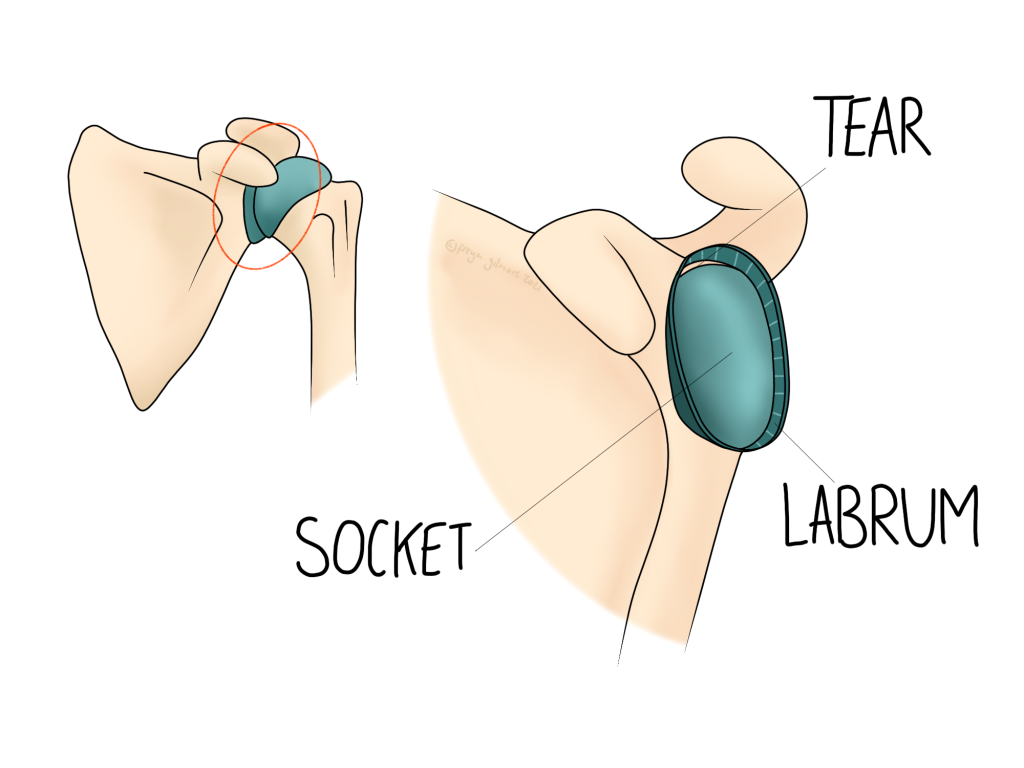 Labrum Injuries