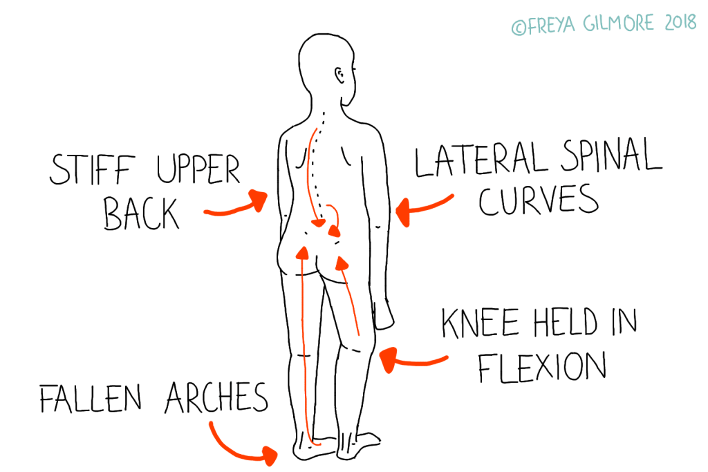 An example of how mild aches and pains can affect the rest of the body