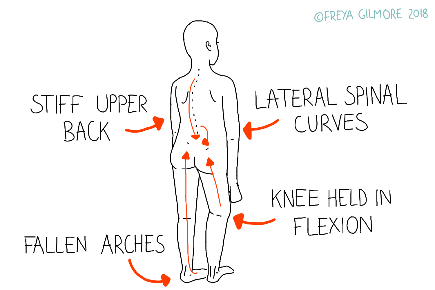 A sketched human figure shows specific postural issues labeled: "STIFF UPPER BACK," "LATERAL SPINAL CURVES," "KNEE HELD IN FLEXION," and "FALLEN ARCHES," with arrows indicating affected areas. ©FREYA GILMORE 2018.
