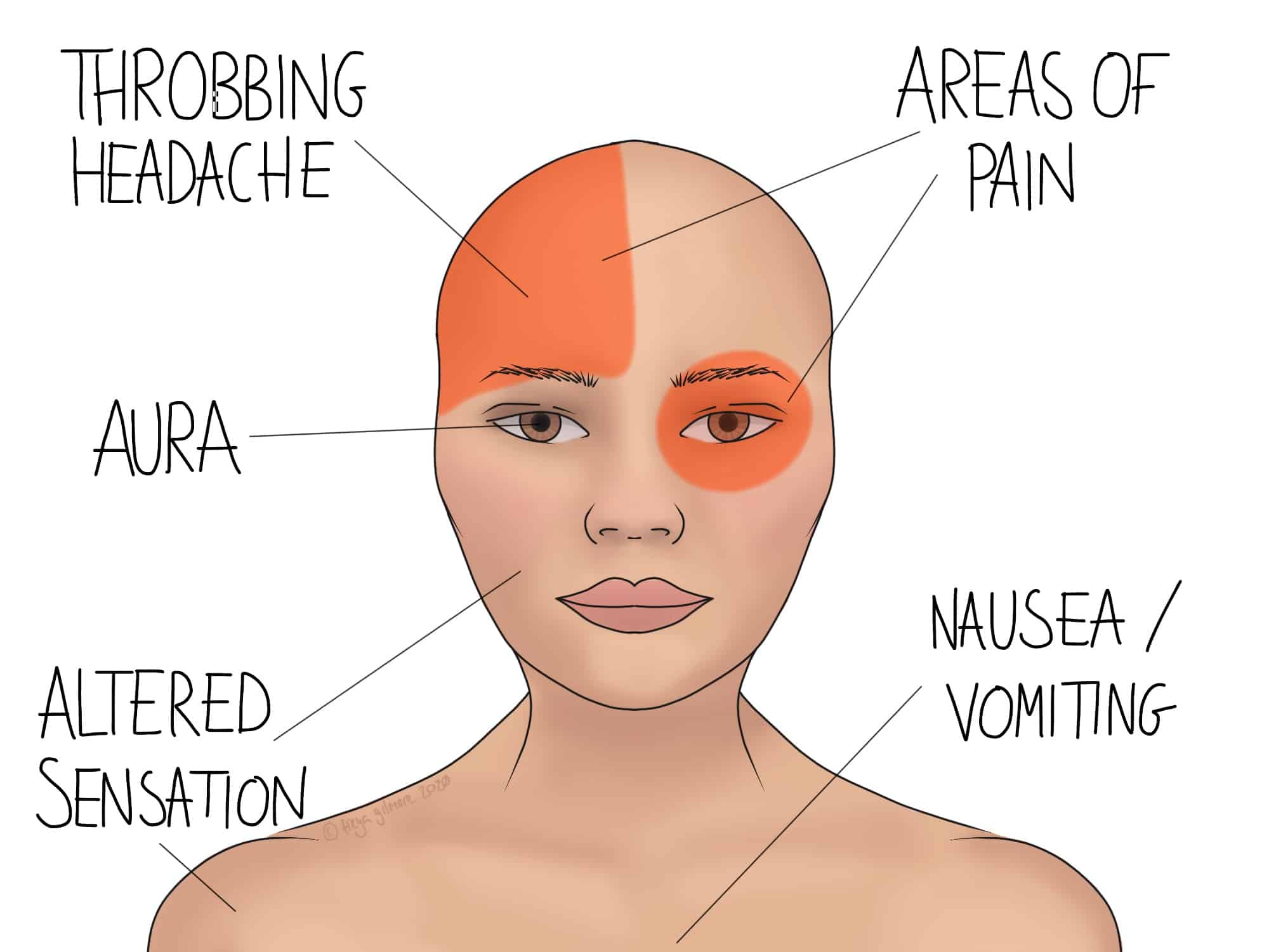 A person's head with highlighted orange areas depicting migraine symptoms, including "THROBBING HEADACHE," "AURA," "ALTERED SENSATION," "AREAS OF PAIN," "NAUSEA/VOMITING," shown through labeled text and color mapping.