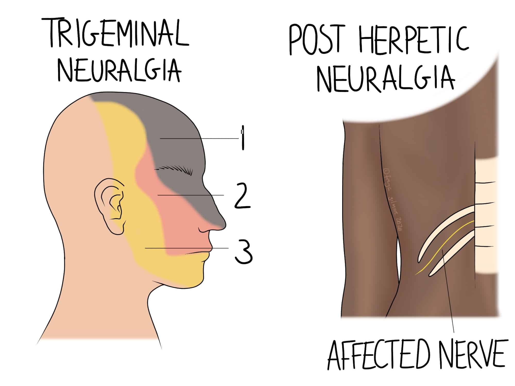 Diagram illustrating trigeminal neuralgia with labeled facial areas 1, 2, and 3, showing pain regions. Adjacent image depicts post-herpetic neuralgia highlighting affected nerves in the back.