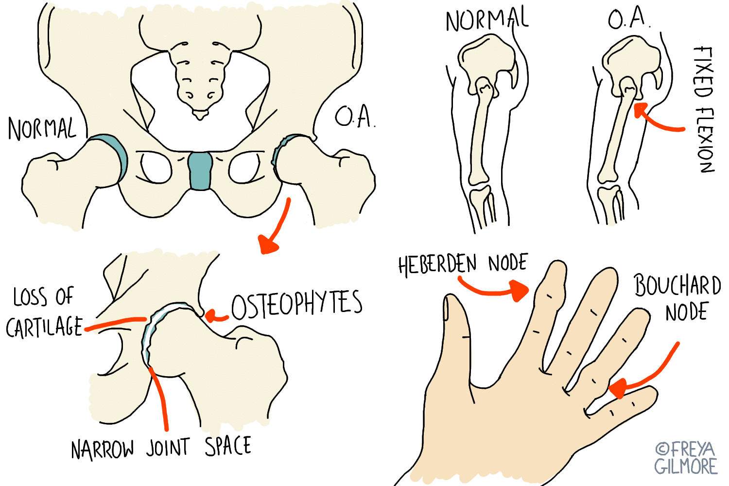 Diagram illustrating osteoarthritis (OA) effects. Hip joints show loss of cartilage, osteophytes, and narrow spaces. Knee comparison between normal and OA with fixed flexion. Hand shows Heberden and Bouchard nodes.