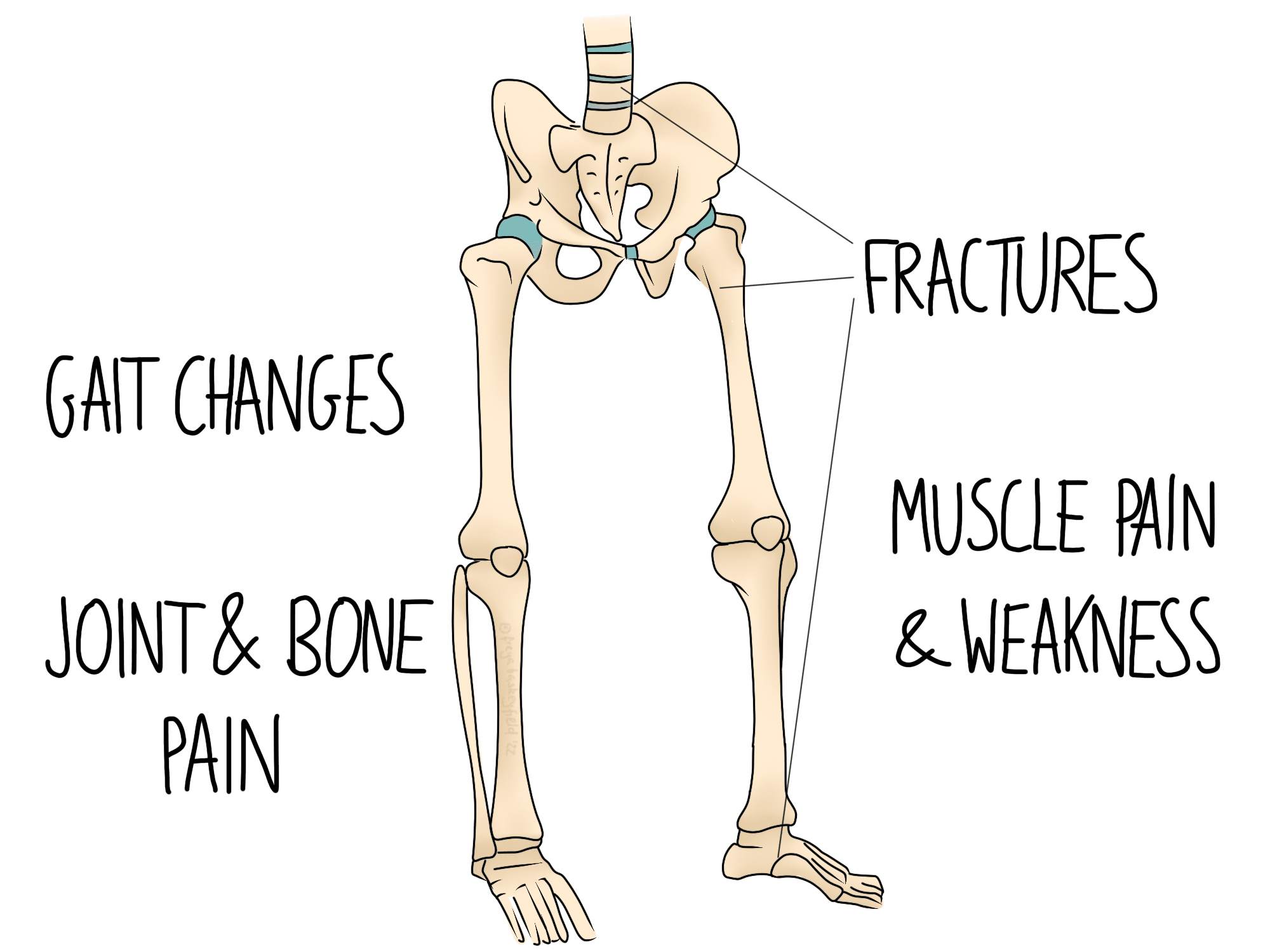 Skeleton legs diagram highlights issues: "GAIT CHANGES," "JOINT & BONE PAIN," "FRACTURES," "MUSCLE PAIN & WEAKNESS." Labels point to bones, illustrating potential problems in a medical context.