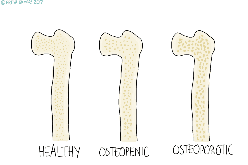 Three bone illustrations compare conditions: "HEALTHY" shows dense structure, "OSTEOPENIC" indicates slight porosity, "OSTEOPOROTIC" displays high porosity. ©FREYA GILMORE 2017 is noted.