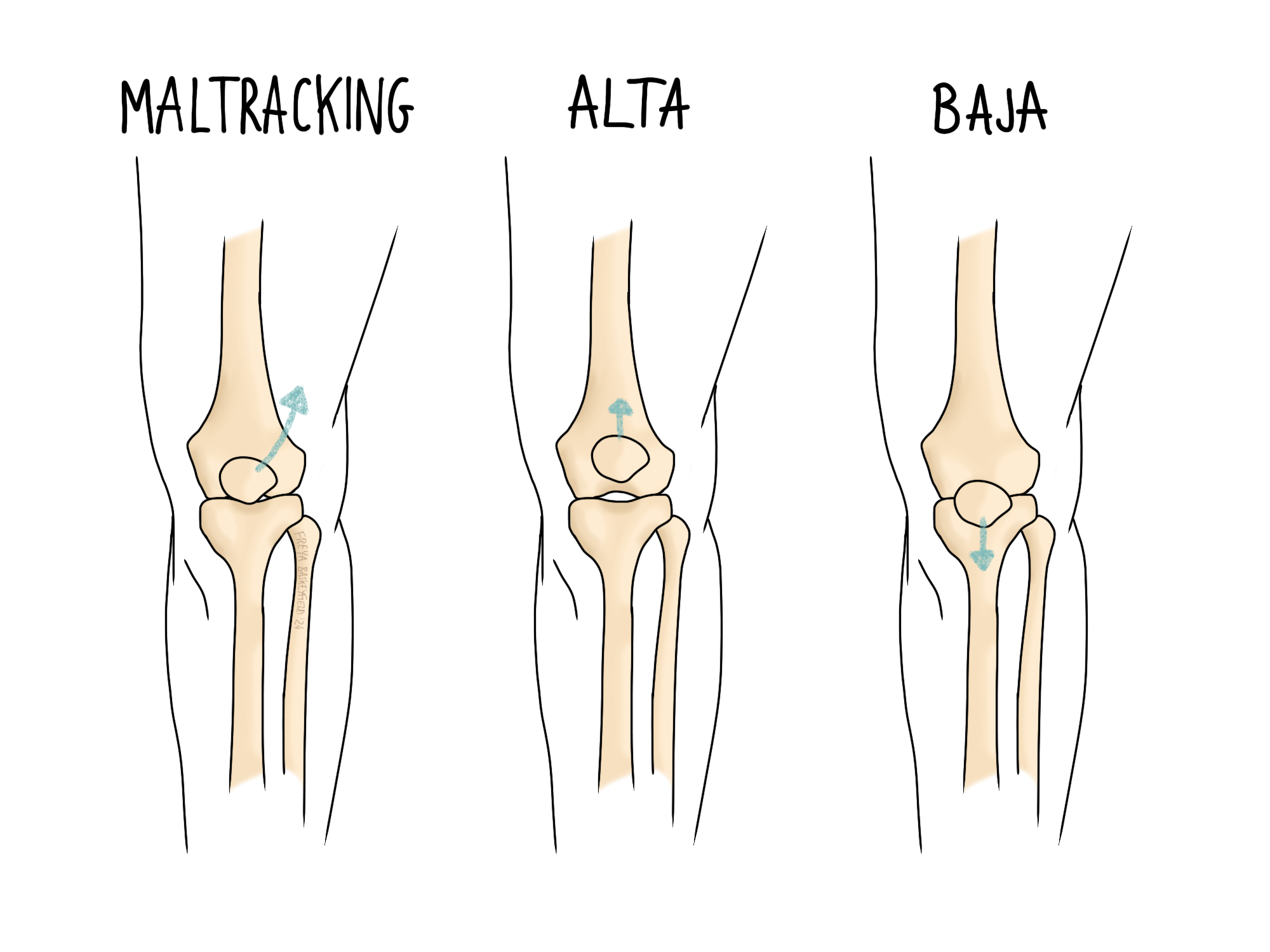 Three diagrams of knee joints labeled "Maltracking," "Alta," and "Baja" depict different kneecap positions with arrows. Each shows the patella's movement: lateral, upward, and downward.
