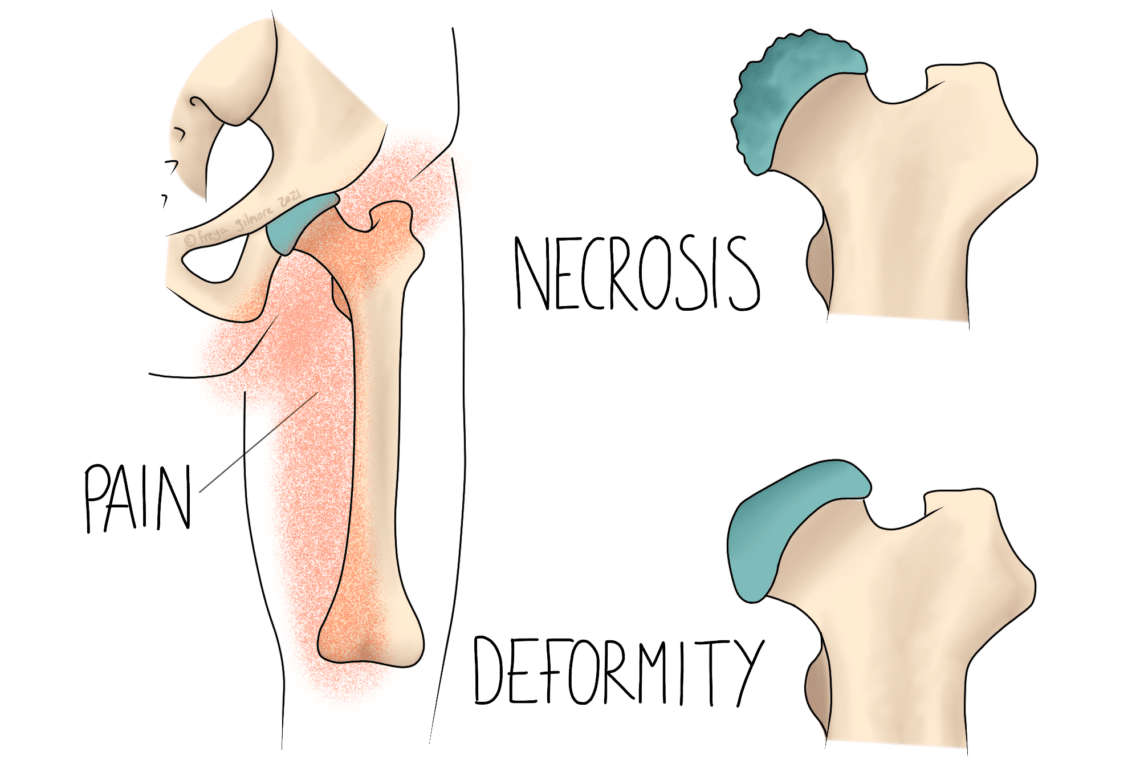 Hip bone illustration shows necrosis and deformity with highlighted areas indicating pain. Labels: "PAIN," "NECROSIS," "DEFORMITY." Surrounding text and graphics emphasize joint issues.