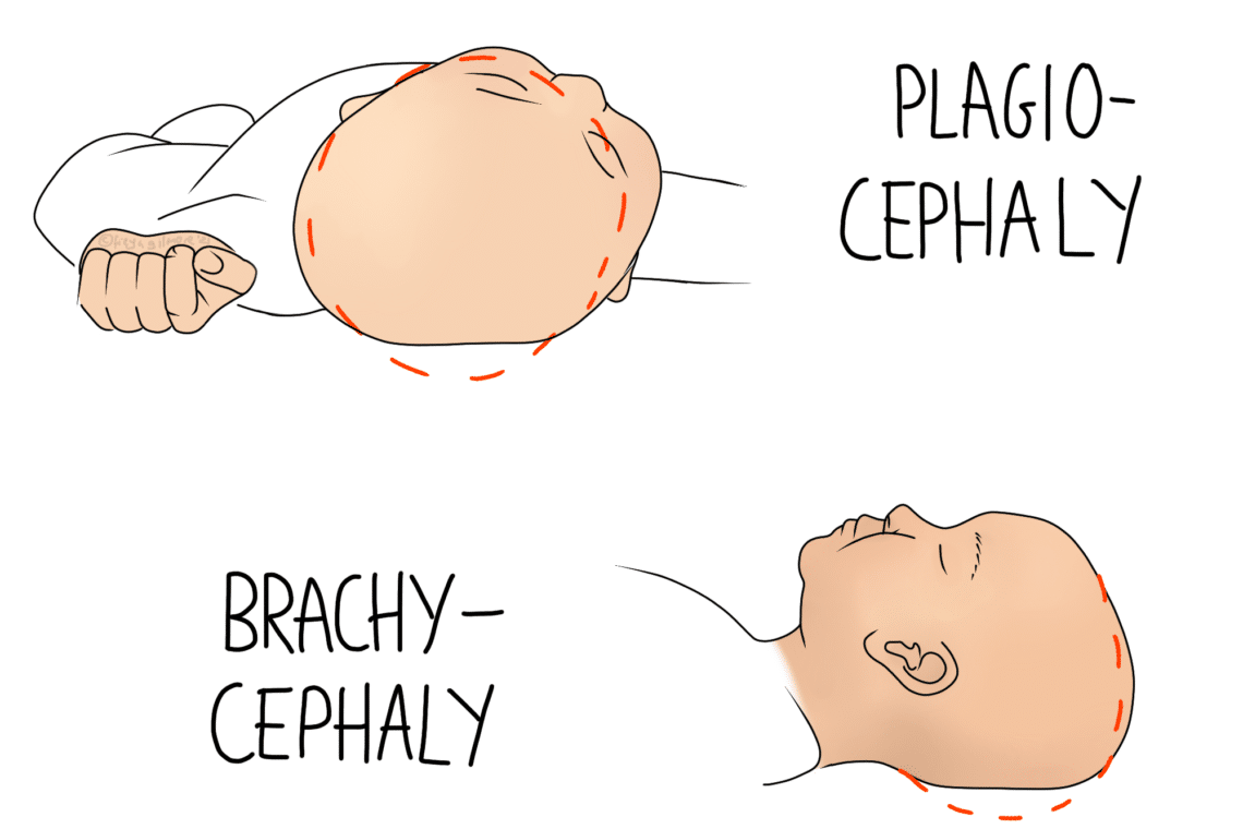 Two outlines illustrate infant head shapes. The top shows "Plagiocephaly" with an asymmetrical head, and the bottom depicts "Brachycephaly" with a flattened back, both labeled with dashed lines.
