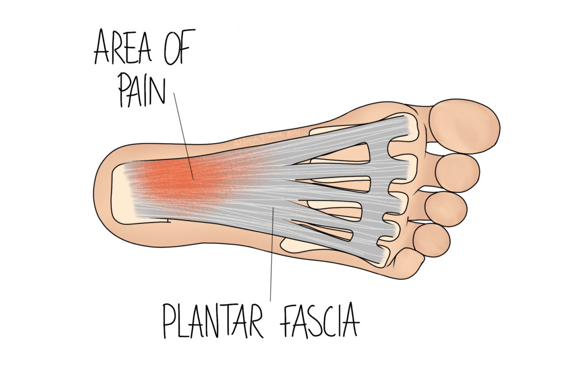 Cross-section of a foot with highlighted plantar fascia, indicating pain. Arrows and text labels identify the "AREA OF PAIN" in red and "PLANTAR FASCIA" in gray.