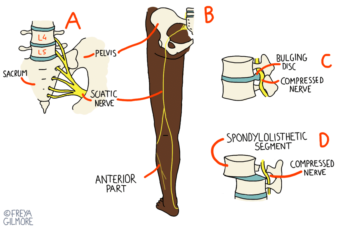 Diagrams illustrating sciatic nerve anatomy and compression causes. Part A shows sacrum, L4/L5 vertebrae, pelvis, sciatic nerve. Part B depicts leg nerve path. Part C shows bulging disc compressing nerve. Part D highlights spondylolisthesis causing compression. Labeled "FREYA GILMORE."