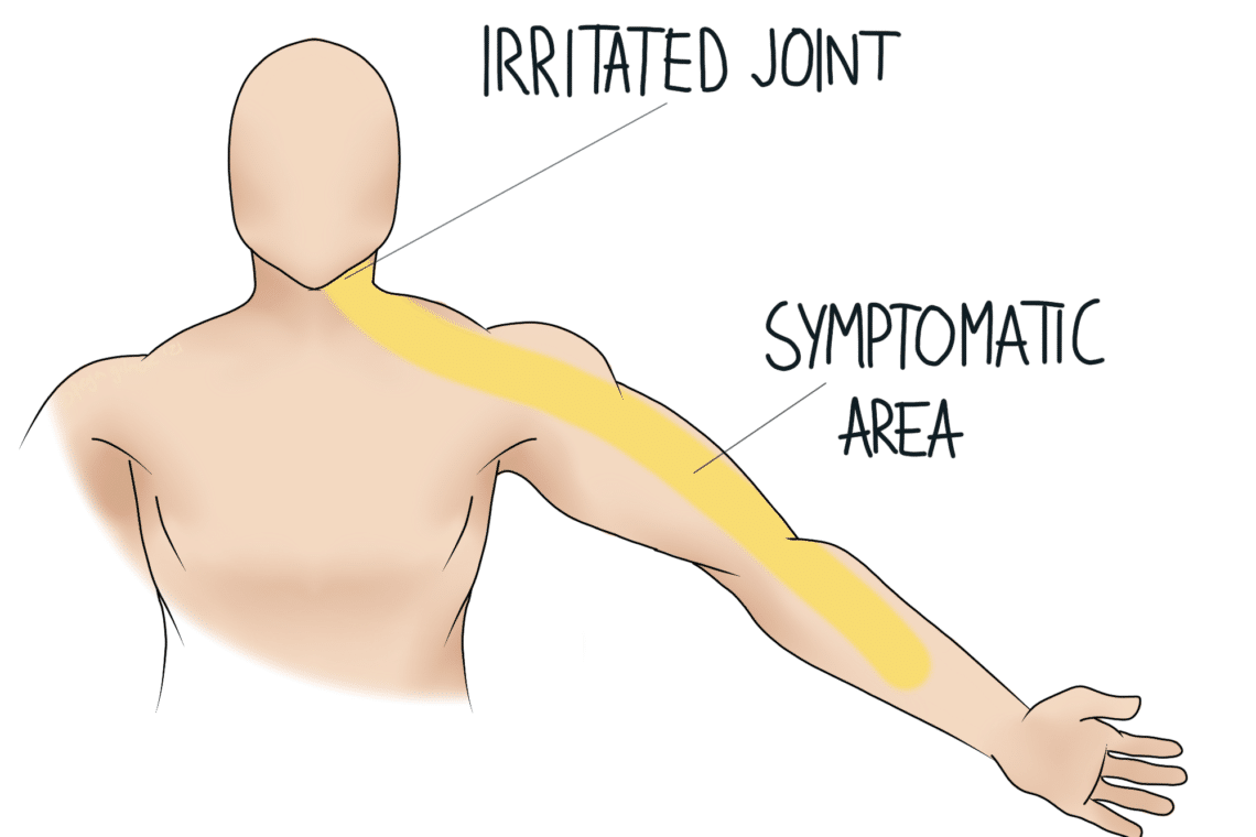 A simplified illustration of an upper body highlights the "Irritated Joint" at the shoulder and a "Symptomatic Area" along the arm in a yellow pathway, indicating a pain location.