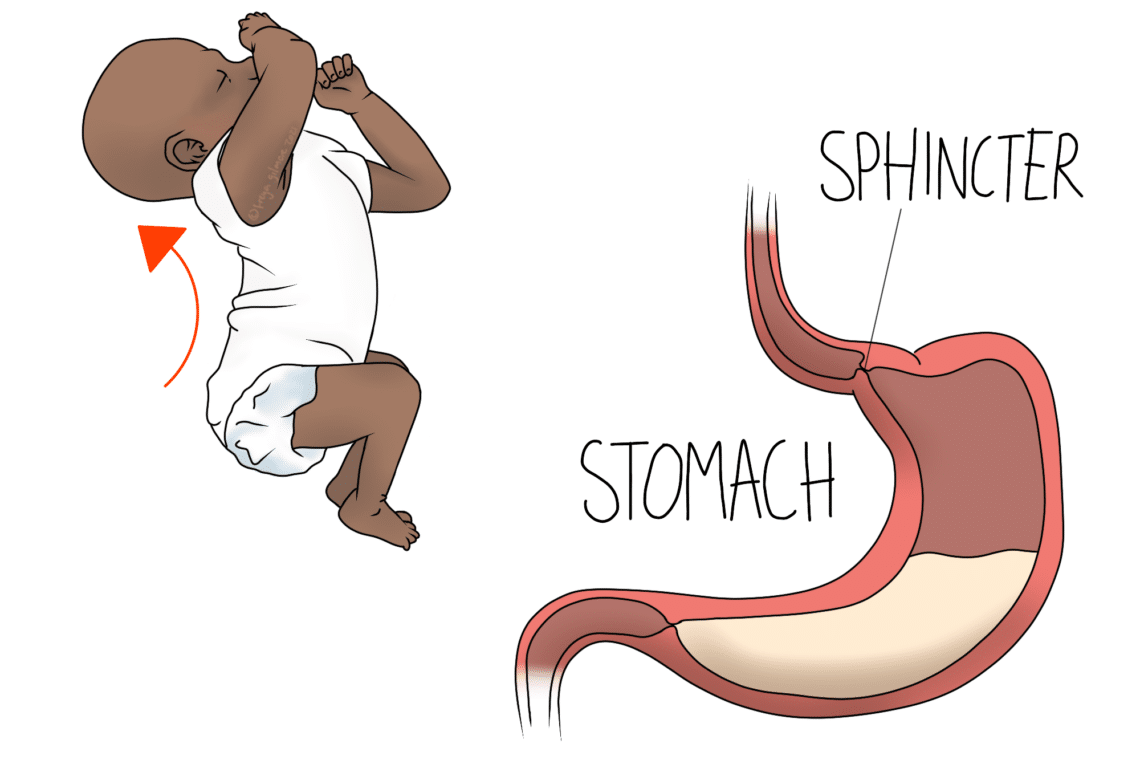 A baby wearing a white onesie is shown curling up with an upward arrow beside it. Next to this, a labeled diagram illustrates a stomach with "SPHINCTER" and "STOMACH."