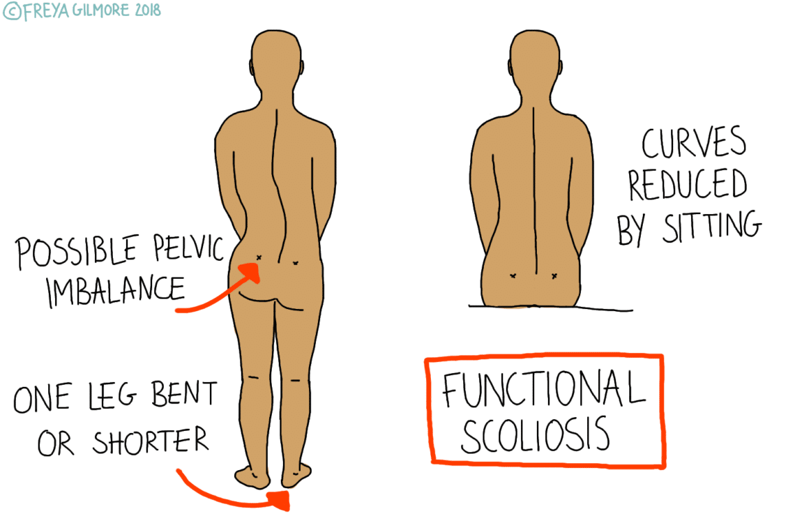 Two illustrations of human backs. The left shows possible pelvic imbalance and one leg bent or shorter. Text: "POSSIBLE PELVIC IMBALANCE," "ONE LEG BENT OR SHORTER." The right shows reduced curves when sitting. Text: "CURVES REDUCED BY SITTING," "FUNCTIONAL SCOLIOSIS." ©FREYA GILMORE 2018.