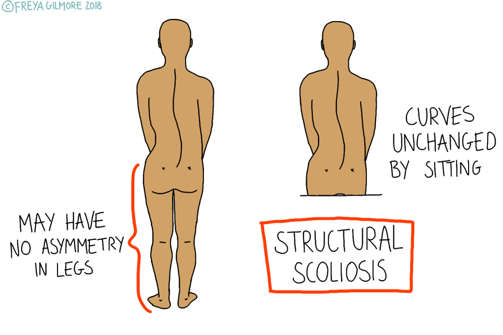 Structural Scoliosis